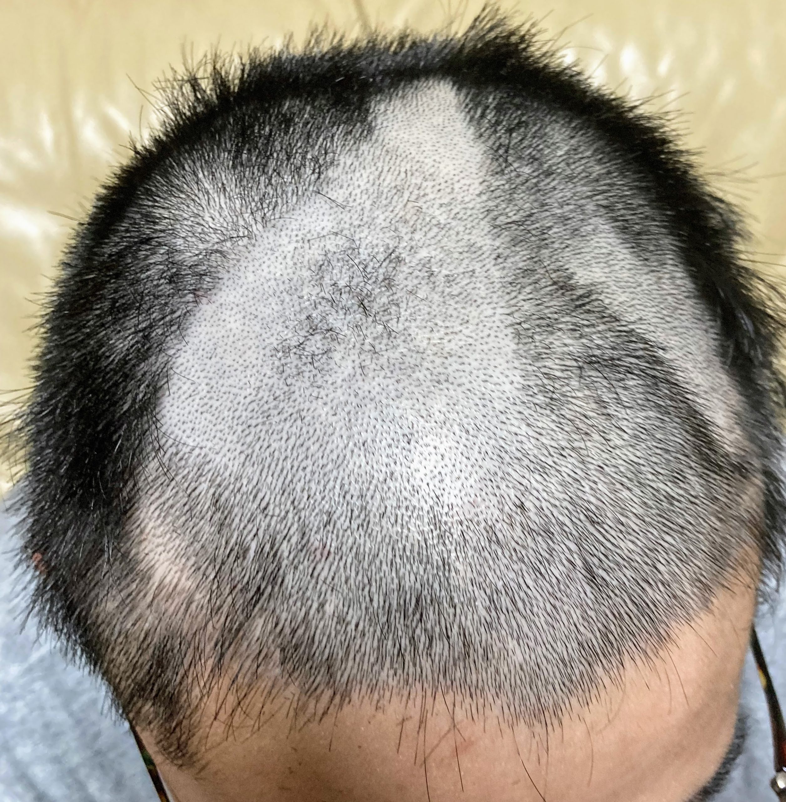 新型コロナウイルスで外出自粛になって高校生の息子が丸坊主にした話し ５丁目通信 仮称
